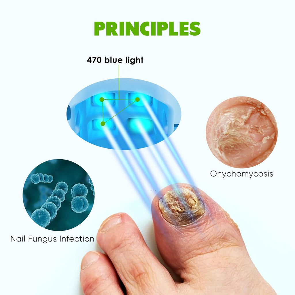 Blue Light for Nail Fungus F78202