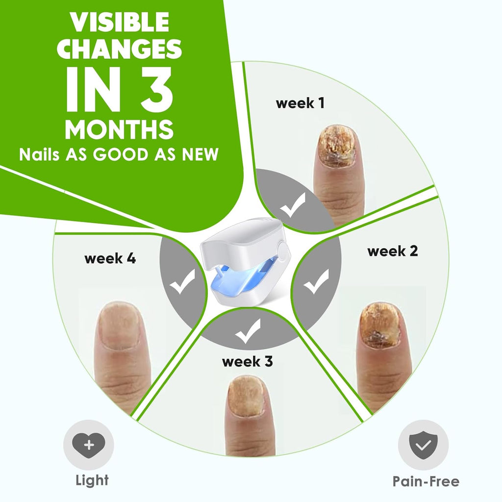Blue Light for Nail Fungus F78202